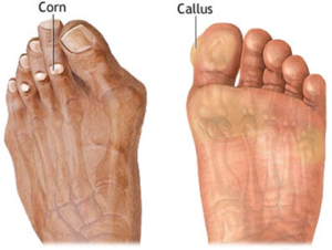 CORNS AND CALLUSES, Foot Medical Centre, Aurora Foot Specialist