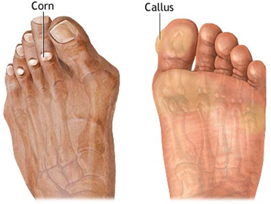 How to Prevent Corns & Calluses: Doctor's Guide