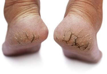 DRY CRACKED HEELS | Foot Medical Centre 