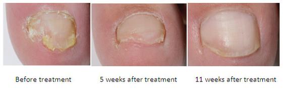 fungal-nail-laser-before-after