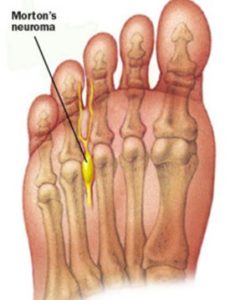 MORTONS NEUROMA | Foot Medical Centre | Newmarket Foot Specialist ...