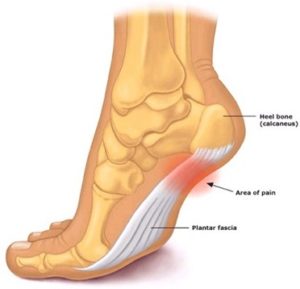 PLANTAR FASCIITIS | Foot Medical Centre | Newmarket Foot Specialist ...