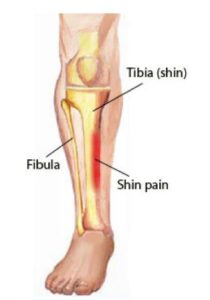 https://www.footmedicalcentre.com/new/wp-content/uploads/2018/01/shin-splints-210x300.jpg